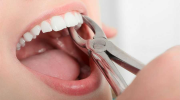 Как подготовиться к удалению зуба