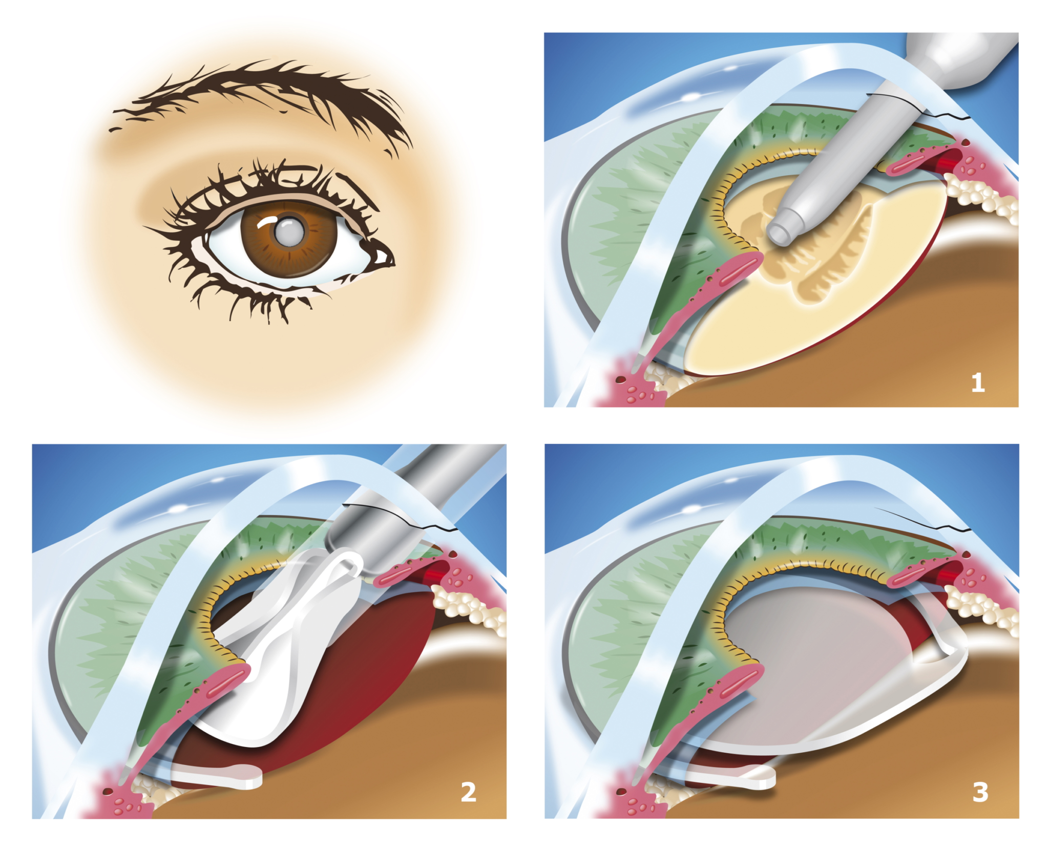 Оперативное лечение катаракты. Катаракта факоэмульсификация. Этапы операции факоэмульсификации катаракты. Ультразвуковая факоэмульсификация катаракты этапы. Факоэмульсификация катаракты с имплантацией интраокулярной линзы.